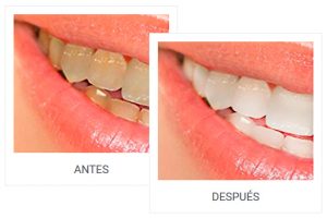 Blanqueamiento de dientes en desntista de Burgos